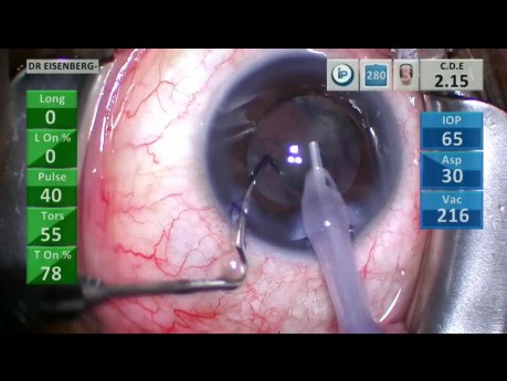 Cataract Surgery with Pseudoexfoliation