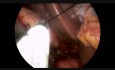 Laparoscopic Single Incision Cholecystectomy