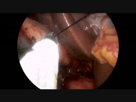 Laparoscopic Single Incision Cholecystectomy