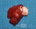 Submandibular Gland Stone [surgical specimen]