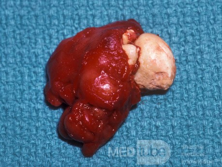Submandibular Gland Stone [surgical specimen]