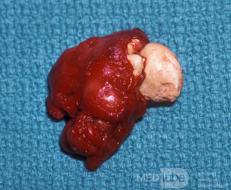 Submandibular Gland Stone [surgical specimen]