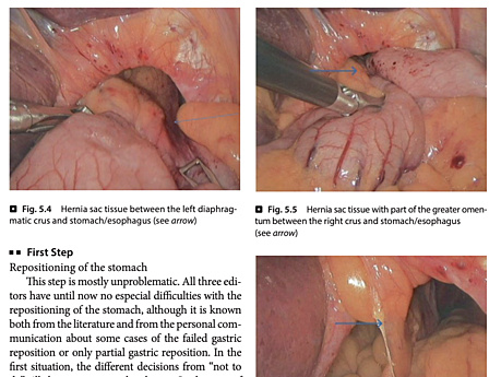 Gastrointestinal Operations and Technical Variations