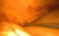 Laparoscopic reoperative biliary surgery