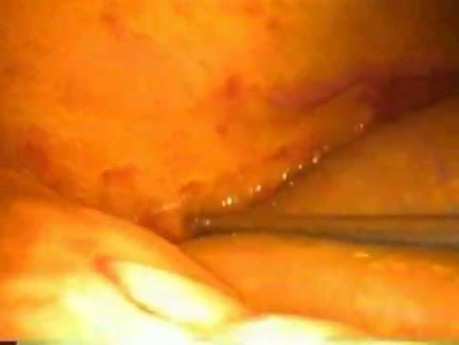 Laparoscopic reoperative biliary surgery