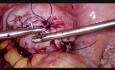 Aquadissection for Myomectomy Multiple Fibroid Removal