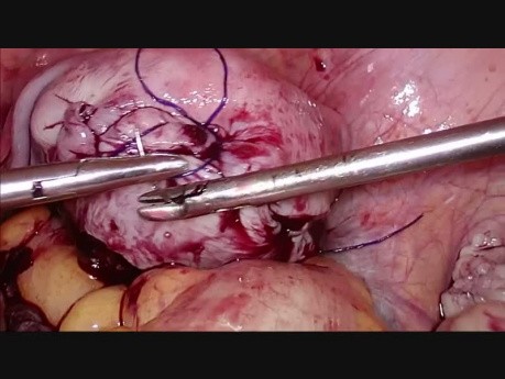 Aquadissection for Myomectomy Multiple Fibroid Removal
