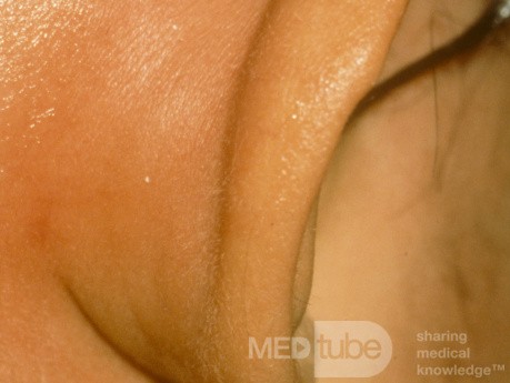 Postauricular Abscess from Mastoiditis