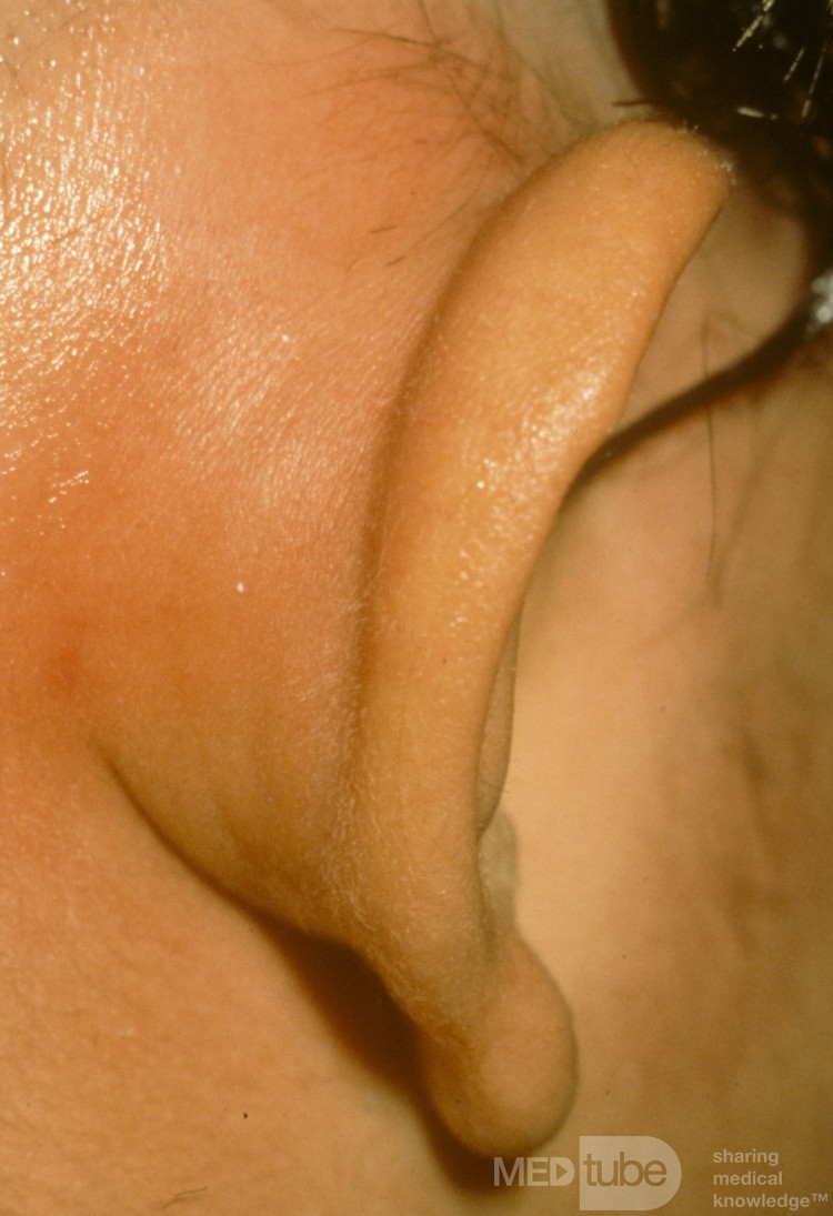 Postauricular Abscess from Mastoiditis