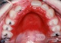 Candida Hard Palate from Dentures