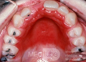 Candida Hard Palate from Dentures