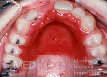 Candida Hard Palate from Dentures