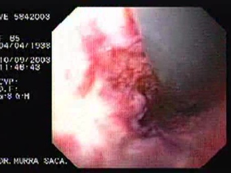 Banding of Esophageal Varices - Cardias in Retroflexed View, Presence of Varices
