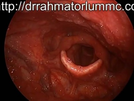 Functional Aphonia - laryngeal movements 