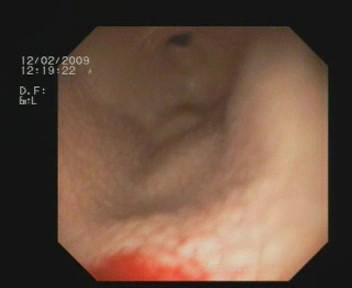 Chronic HP Infection Lymphoid Antral Hyperplasia 