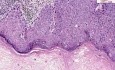 Carcinoma in situ - Histopathology of penis