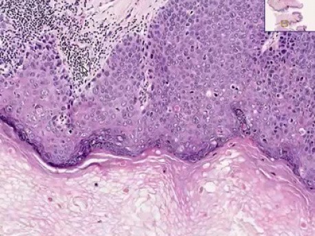 Carcinoma in situ - Histopathology of penis