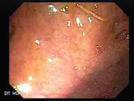 Trichuris Trichura (whipworm) (2 of 3)