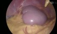 Laparoscopic Splenectomy
