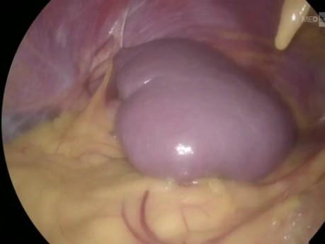 Laparoscopic Splenectomy