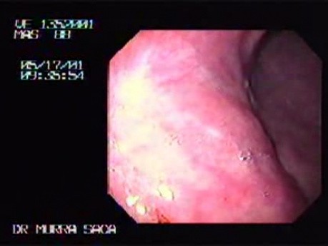 Scars of the Gastric Corpus