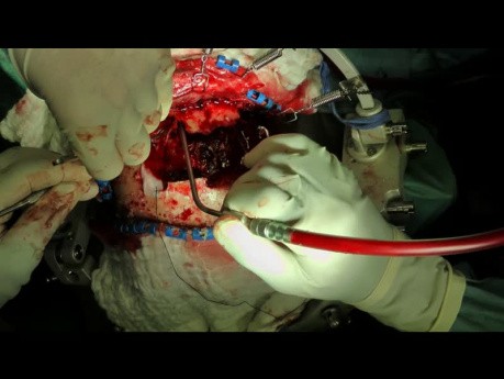  Traumatic Brain Injury