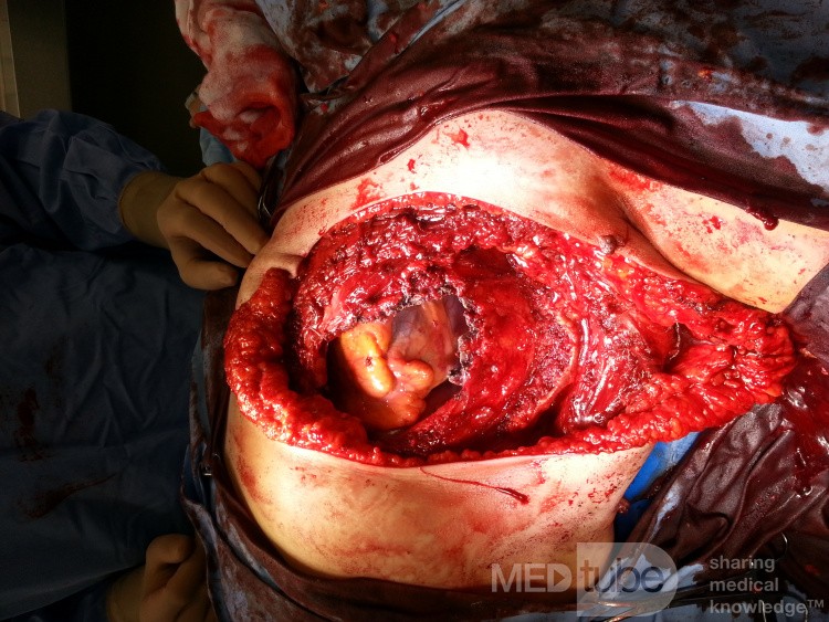 The Defect in the Thoracic Wall and Pericardium Left Intact After the Removal of the Liposarcoma of the Left Breast