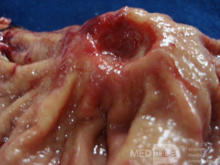 Diffuse Adenocarcinoma with signet ring cells (4 of 18)