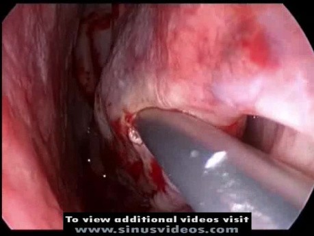 Inferior Turbinate Submucous Resection (SMR)