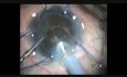 Coloboma and Hard Cataract