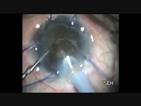 Coloboma and Hard Cataract