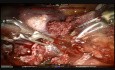 Superior Robotic Lobectomy