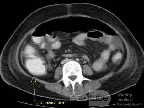 Multiple Rectal Ulcers (41 of 110)