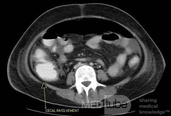 Multiple Rectal Ulcers (41 of 110)