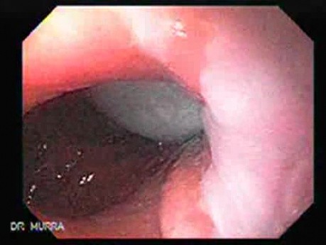 Intragastric Balloon - The Treatment Of Obesity (11 of 13)