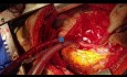 Bilateral Pulmonary Artery Sarcoma