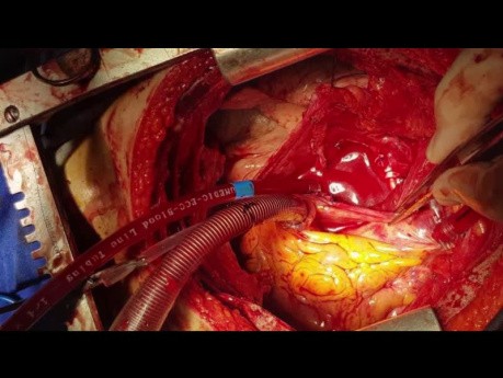 Bilateral Pulmonary Artery Sarcoma