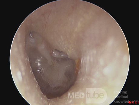 Adhesive Otitis Media