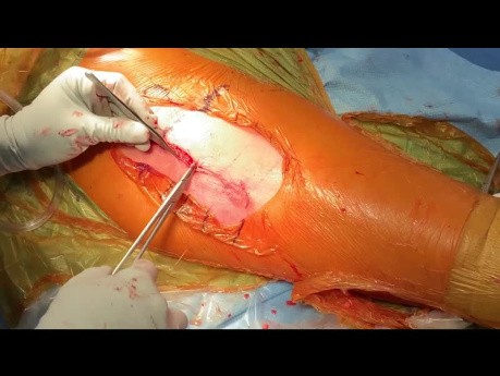 THA: 3 Layer Closure Using Quill Barbed Suture