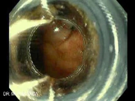 Upper GI Bleeding Due to Esophageal Varices - Necrotic Varix