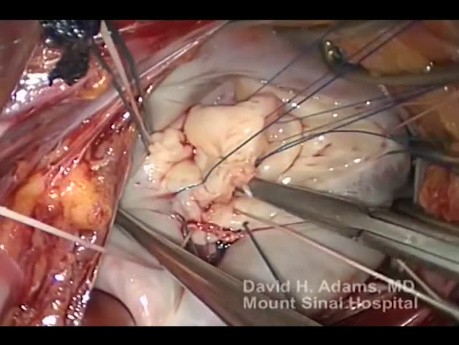 Mitral Valve Repair of Fibroelastic Deficiency with Posterior Leaflet Prolapse