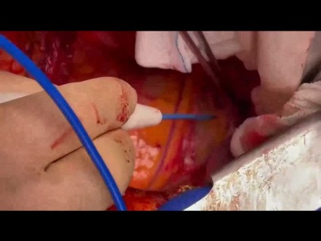 Performing Redo CABG with Posterolateral Thoracotomy Incision