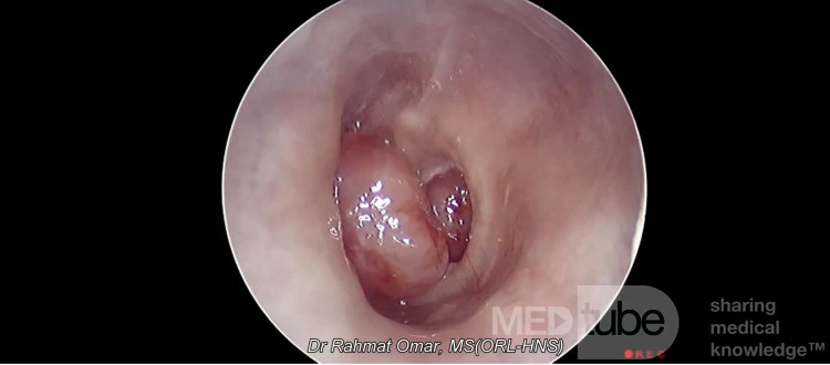 Middle Ear Polyp