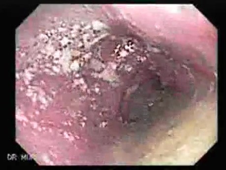 Esophageal Achalasia (1 of 10)