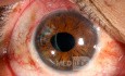 Follow up: Blunt Ocular Trauma, Phacotrabeculectomy and Iris Repair