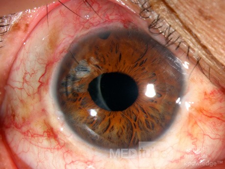 Follow up: Blunt Ocular Trauma, Phacotrabeculectomy and Iris Repair