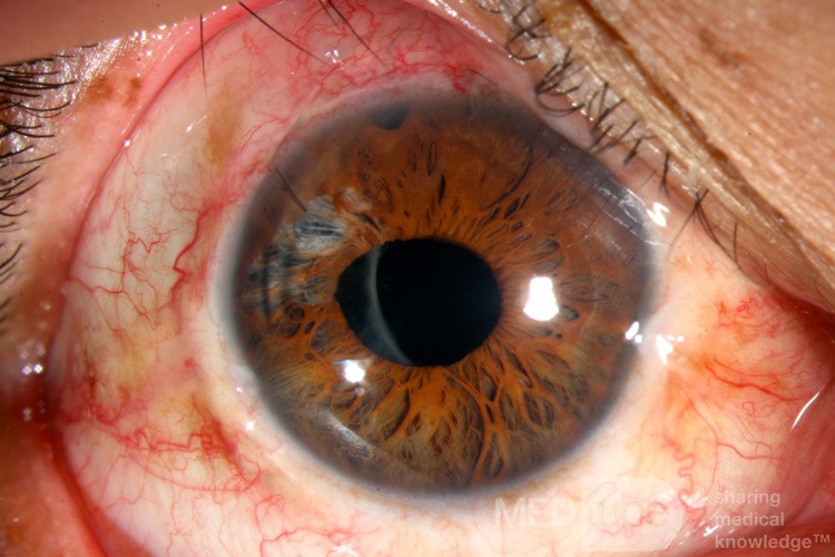 Follow up: Blunt Ocular Trauma, Phacotrabeculectomy and Iris Repair