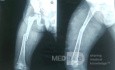 Non Operative External Fixation of Femur in a 3 Years Old Female