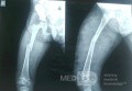 Non Operative External Fixation of Femur in a 3 Years Old Female