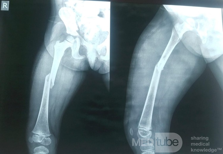 Non Operative External Fixation of Femur in a 3 Years Old Female